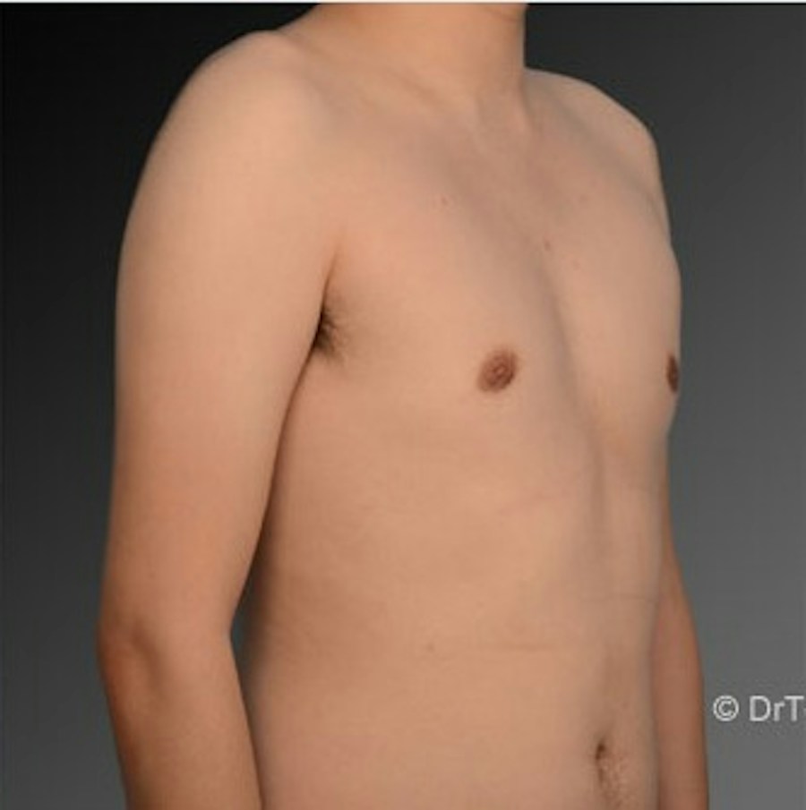 Patient 106041472 | Angle View | After | Chest (Gynecomastia) — Steven Teitelbaum MD -