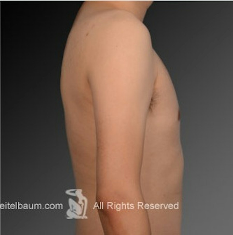 Patient 106041472 | Profile View | After | Chest (Gynecomastia) — Steven Teitelbaum MD -