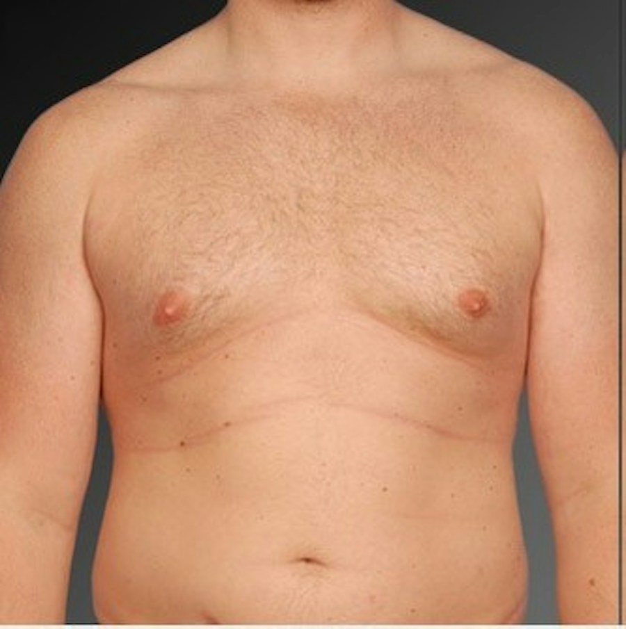 Patient 106041473 | Front View | Before | Chest (Gynecomastia) — Steven Teitelbaum MD -