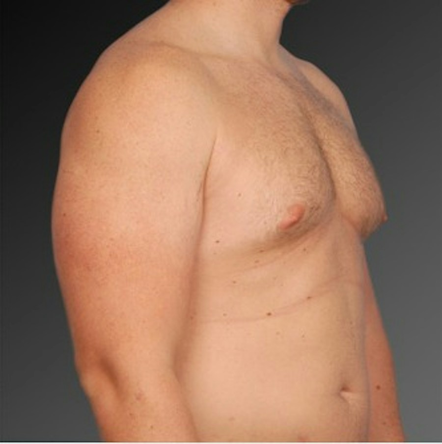 Patient 106041473 | Angle View | Before | Chest (Gynecomastia) — Steven Teitelbaum MD -