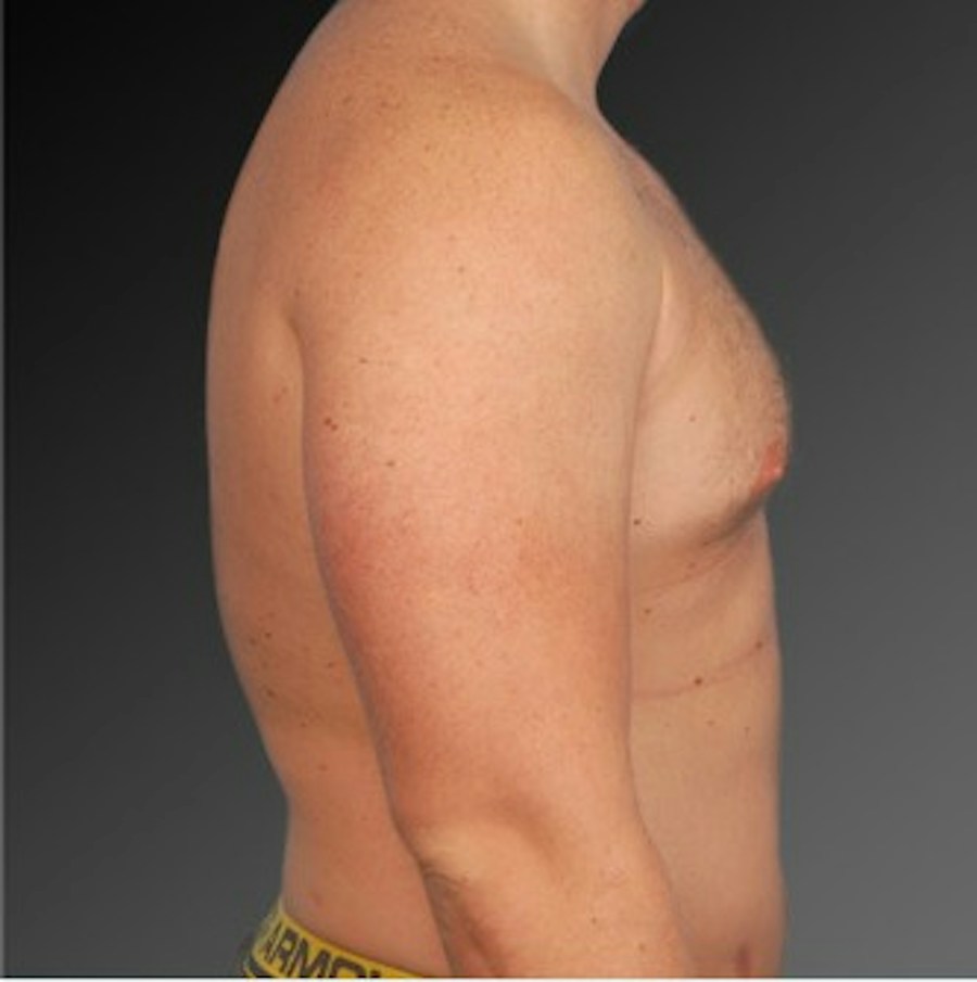 Patient 106041473 | Profile View | Before | Chest (Gynecomastia) — Steven Teitelbaum MD -