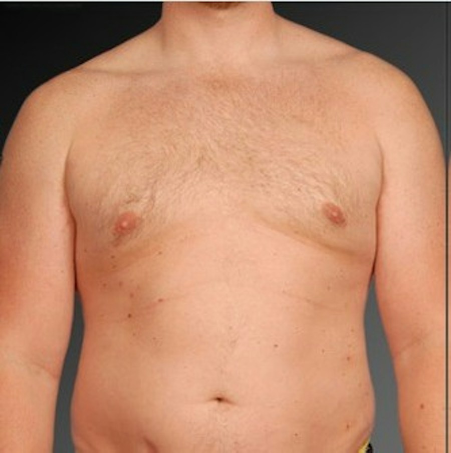 Patient 106041473 | Front View | After | Chest (Gynecomastia) — Steven Teitelbaum MD -