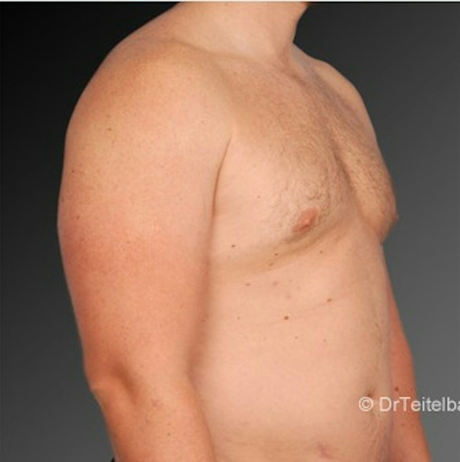 Patient 106041473 | Angle View | After | Chest (Gynecomastia) — Steven Teitelbaum MD -