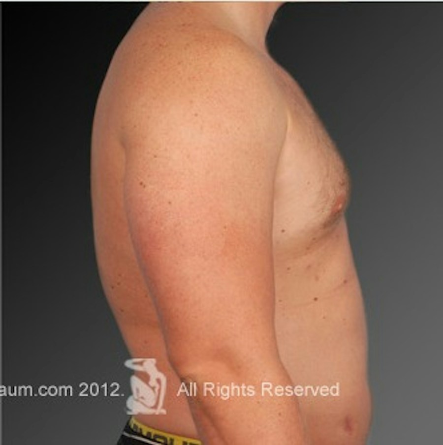 Patient 106041473 | Profile View | After | Chest (Gynecomastia) — Steven Teitelbaum MD -