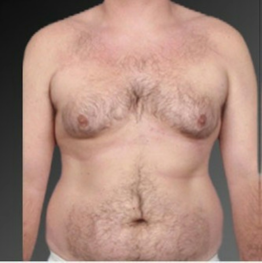 Patient 106041474 | Front View | Before | Chest (Gynecomastia) — Steven Teitelbaum MD -