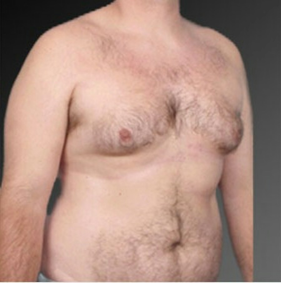 Patient 106041474 | Angle View | Before | Chest (Gynecomastia) — Steven Teitelbaum MD -