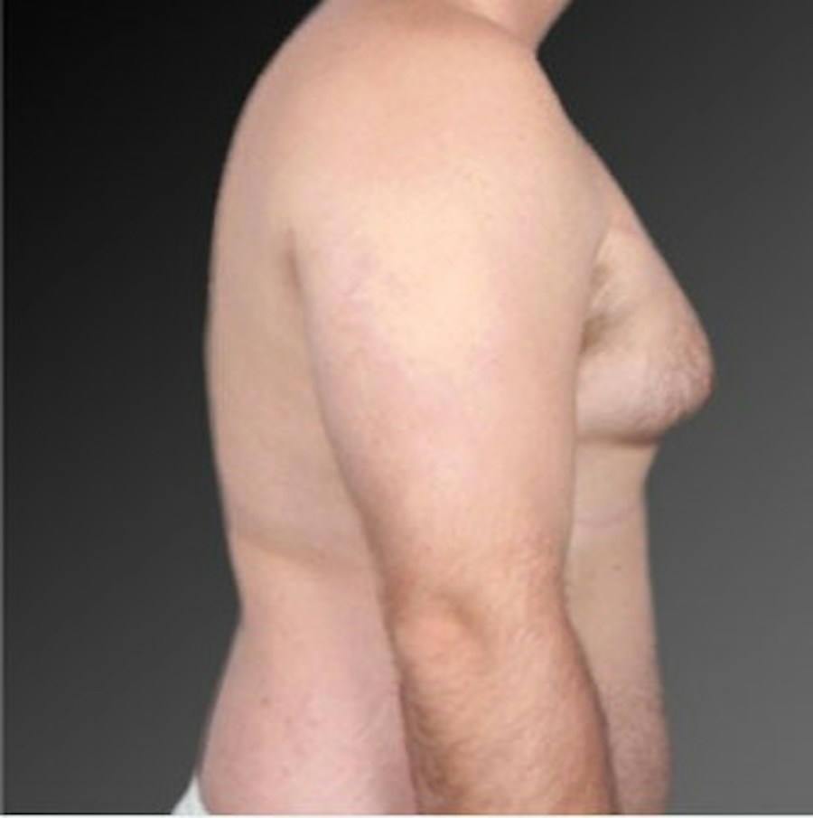 Patient 106041474 | Profile View | Before | Chest (Gynecomastia) — Steven Teitelbaum MD -