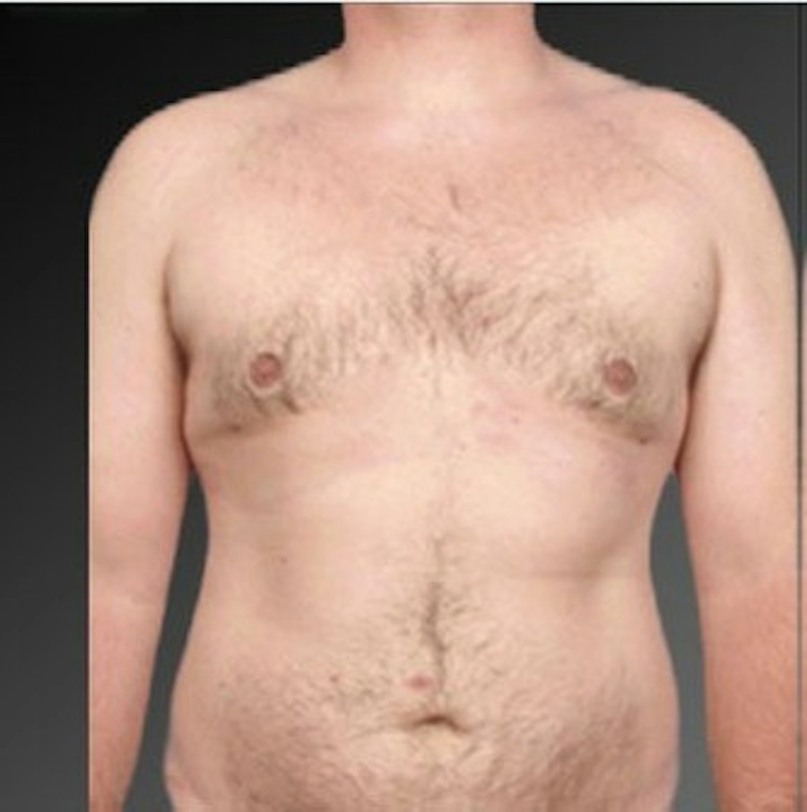 Patient 106041474 | Front View | After | Chest (Gynecomastia) — Steven Teitelbaum MD -