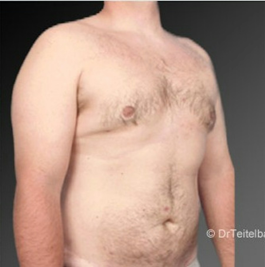 Patient 106041474 | Angle View | After | Chest (Gynecomastia) — Steven Teitelbaum MD -