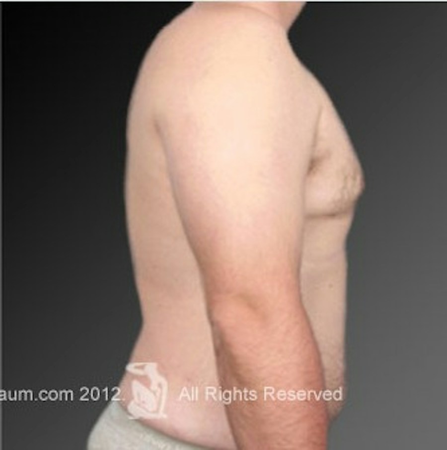 Patient 106041474 | Profile View | After | Chest (Gynecomastia) — Steven Teitelbaum MD -