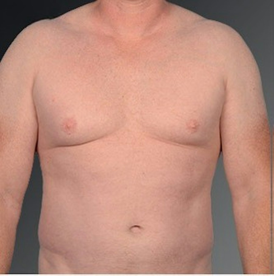 Patient 106041475 | Front View | Before | Chest (Gynecomastia) — Steven Teitelbaum MD -