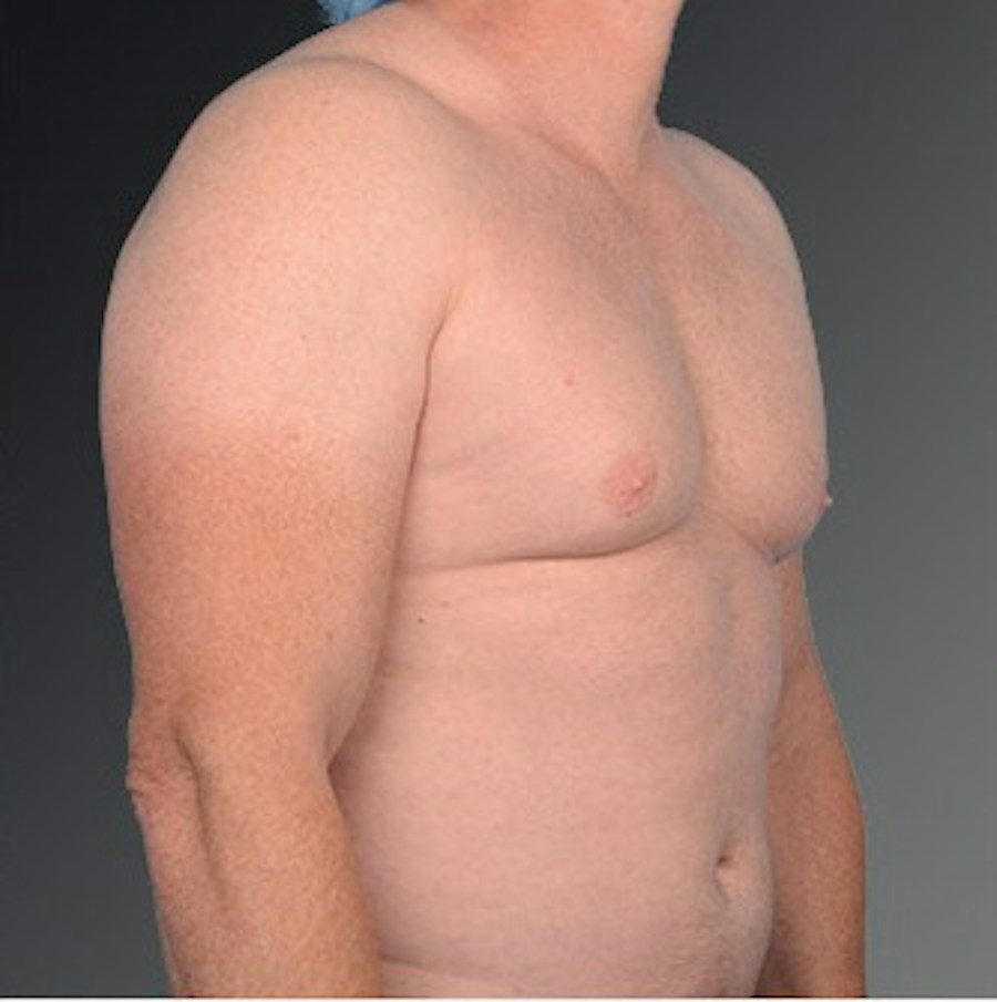 Patient 106041475 | Angle View | Before | Chest (Gynecomastia) — Steven Teitelbaum MD -