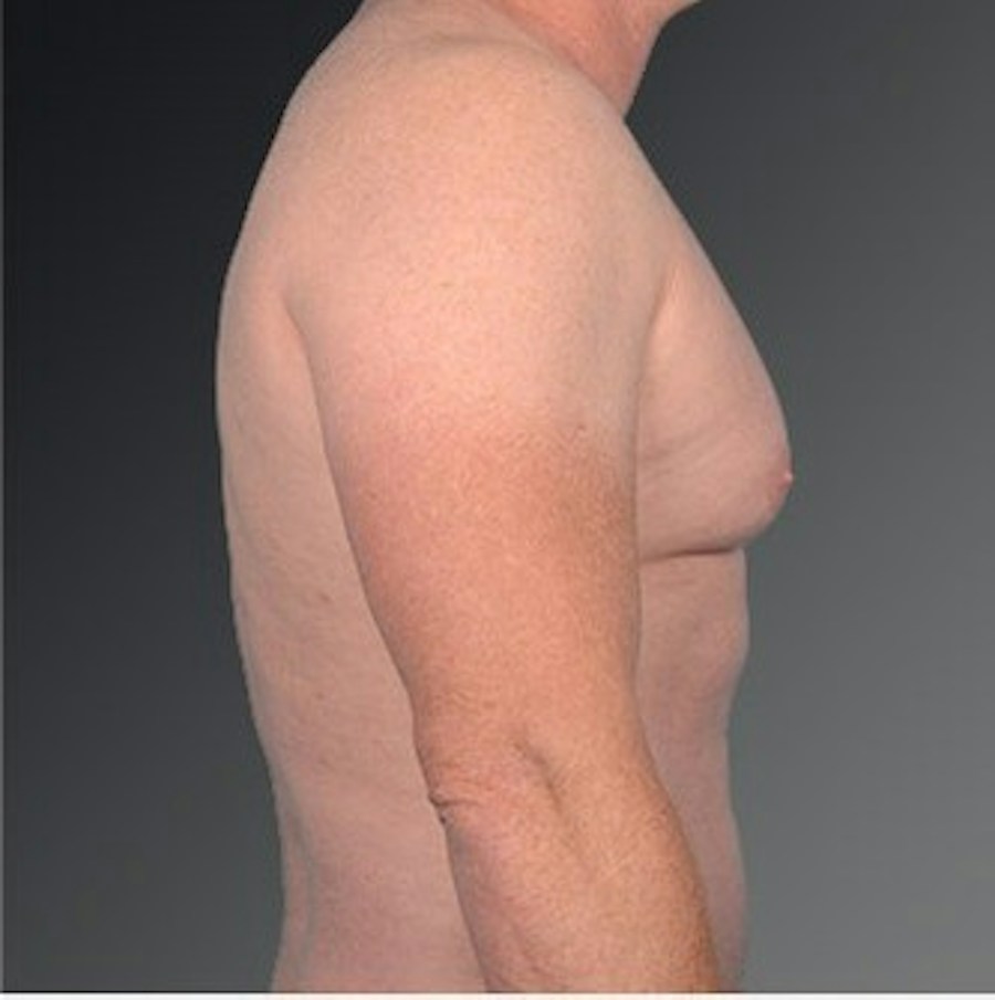 Patient 106041475 | Profile View | Before | Chest (Gynecomastia) — Steven Teitelbaum MD -