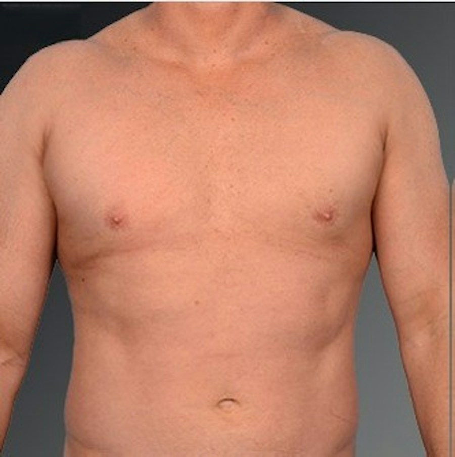 Patient 106041475 | Front View | After | Chest (Gynecomastia) — Steven Teitelbaum MD -