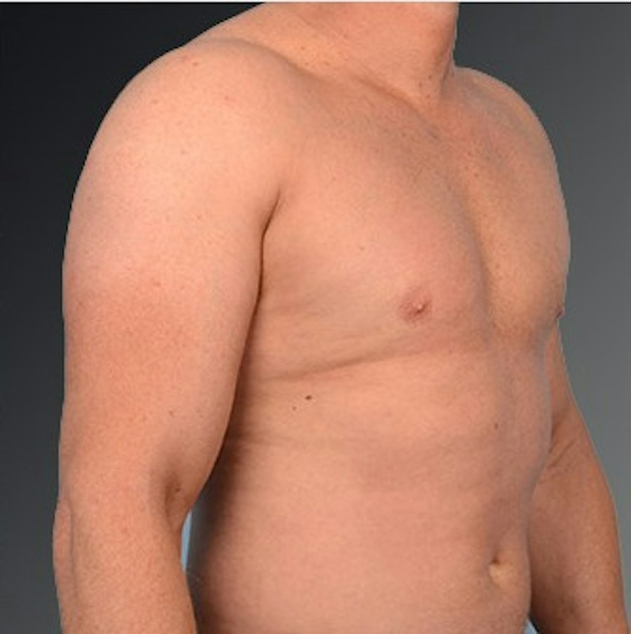 Patient 106041475 | Angle View | After | Chest (Gynecomastia) — Steven Teitelbaum MD -