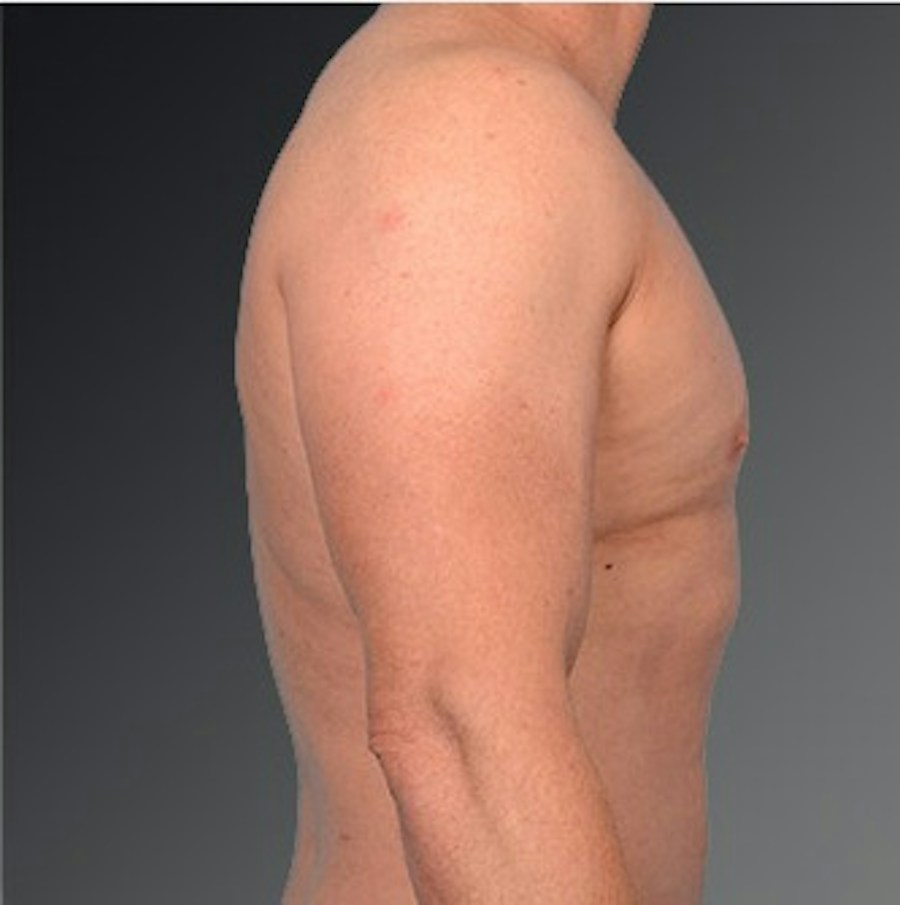 Patient 106041475 | Profile View | After | Chest (Gynecomastia) — Steven Teitelbaum MD -