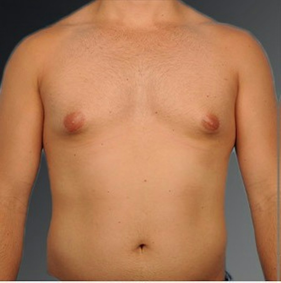 Patient 106041477 | Front View | Before | Chest (Gynecomastia) — Steven Teitelbaum MD -
