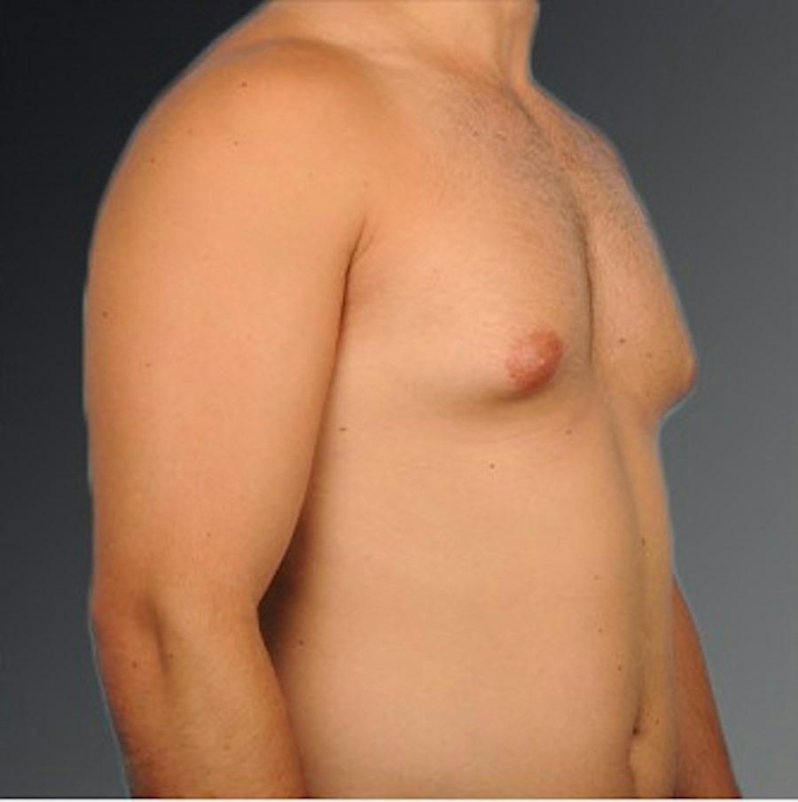 Patient 106041477 | Angle View | Before | Chest (Gynecomastia) — Steven Teitelbaum MD -