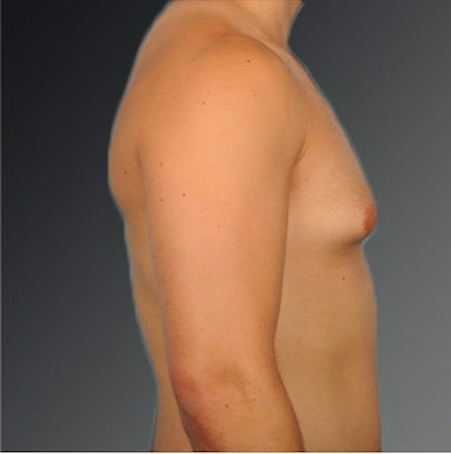 Patient 106041477 | Profile View | Before | Chest (Gynecomastia) — Steven Teitelbaum MD -