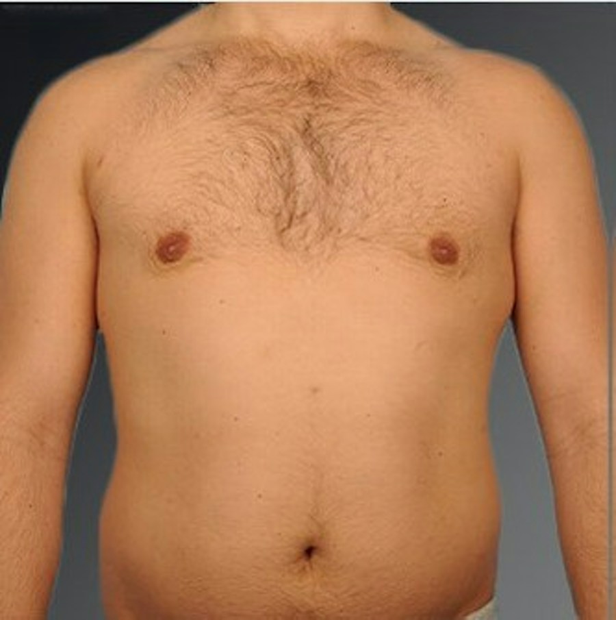 Patient 106041477 | Front View | After | Chest (Gynecomastia) — Steven Teitelbaum MD -