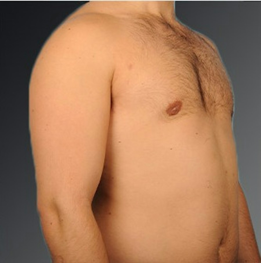 Patient 106041477 | Angle View | After | Chest (Gynecomastia) — Steven Teitelbaum MD -
