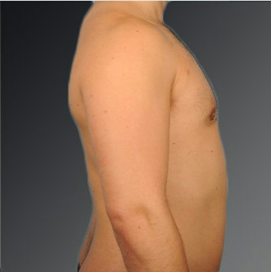 Patient 106041477 | Profile View | After | Chest (Gynecomastia) — Steven Teitelbaum MD -
