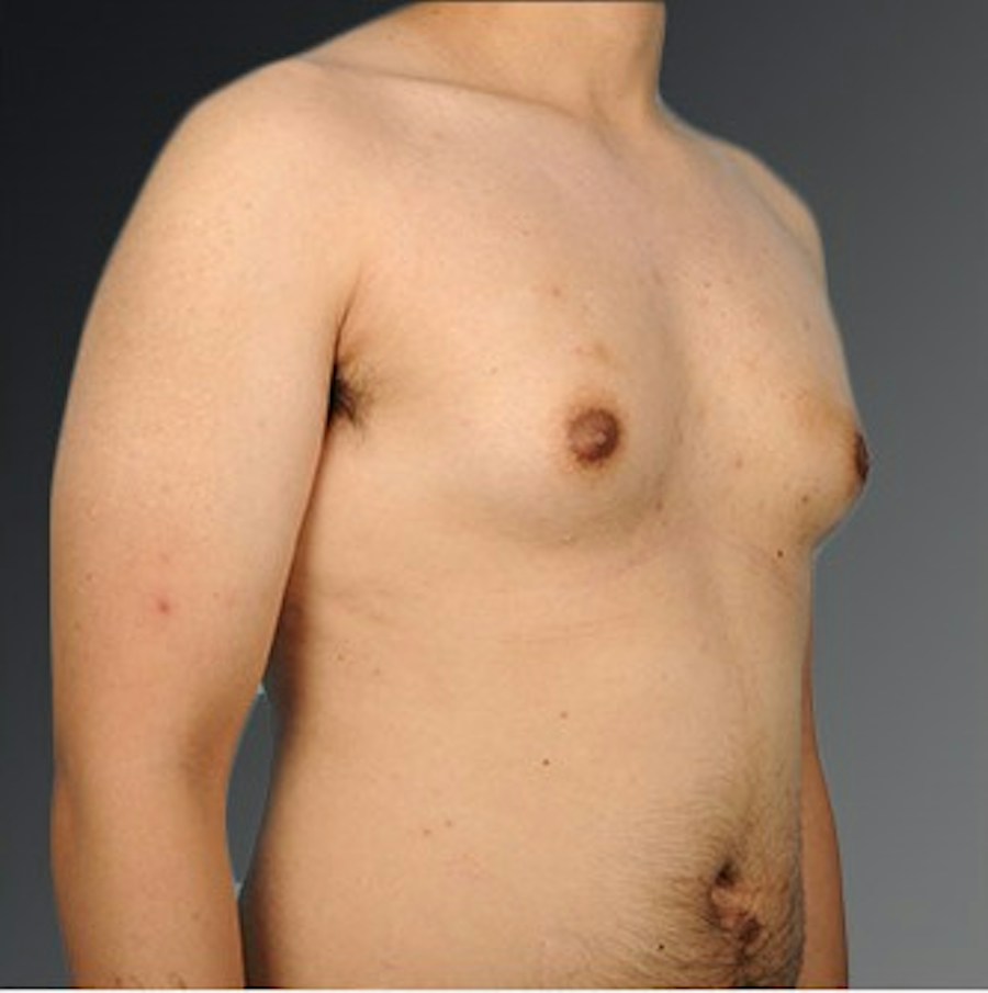 Patient 106041478 | Angle View | Before | Chest (Gynecomastia) — Steven Teitelbaum MD -
