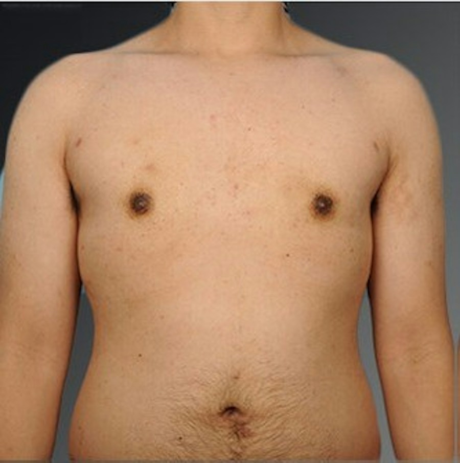 Patient 106041478 | Front View | After | Chest (Gynecomastia) — Steven Teitelbaum MD -