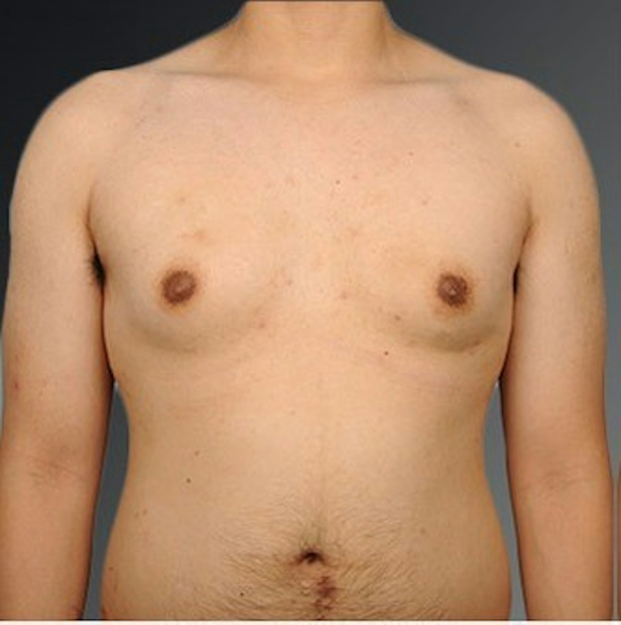 Patient 106041478 | Front View | Before | Chest (Gynecomastia) — Steven Teitelbaum MD -