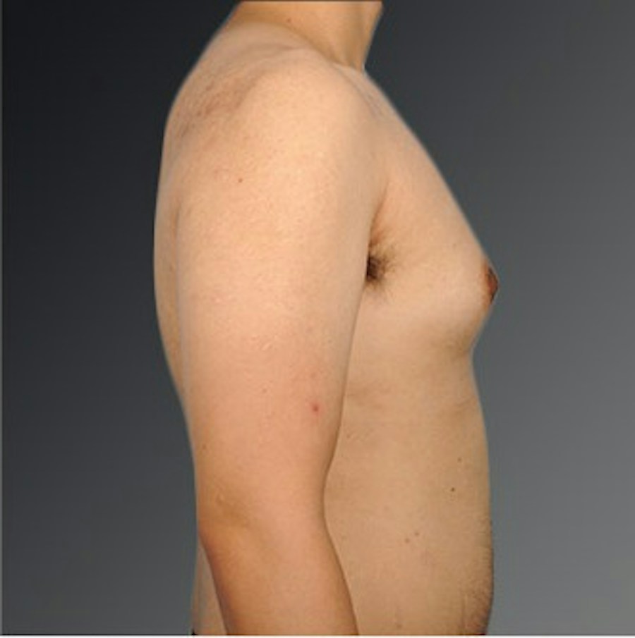 Patient 106041478 | Profile View | Before | Chest (Gynecomastia) — Steven Teitelbaum MD -