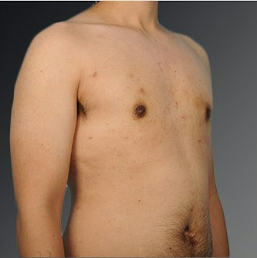 Patient 106041478 | Angle View | After | Chest (Gynecomastia) — Steven Teitelbaum MD -