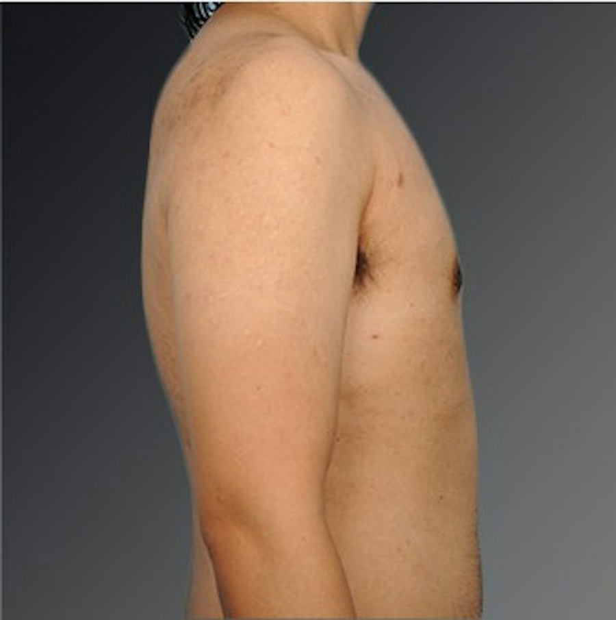 Patient 106041478 | Profile View | After | Chest (Gynecomastia) — Steven Teitelbaum MD -