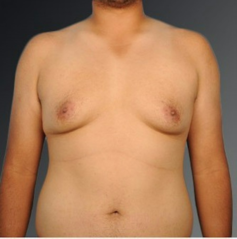 Patient 106041479 | Front View | Before | Chest (Gynecomastia) — Steven Teitelbaum MD -