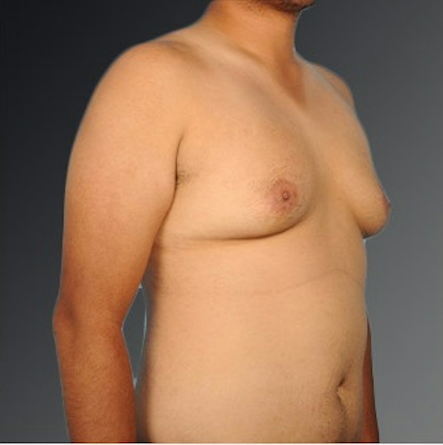 Patient 106041479 | Angle View | Before | Chest (Gynecomastia) — Steven Teitelbaum MD -