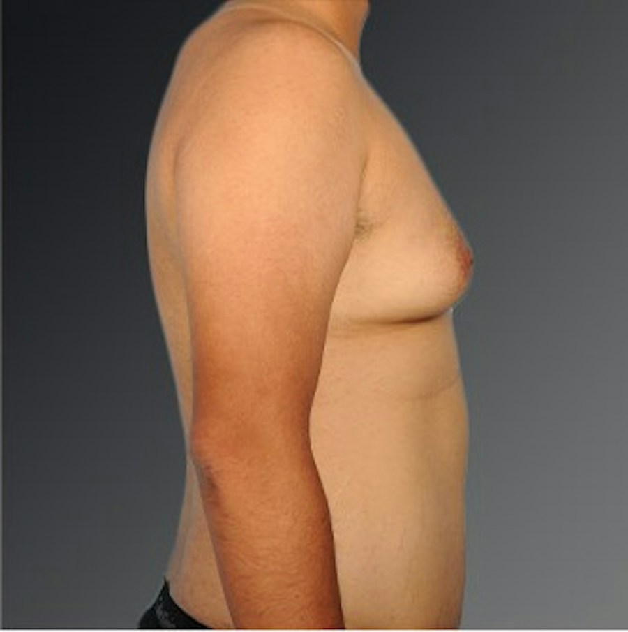 Patient 106041479 | Profile View | Before | Chest (Gynecomastia) — Steven Teitelbaum MD -