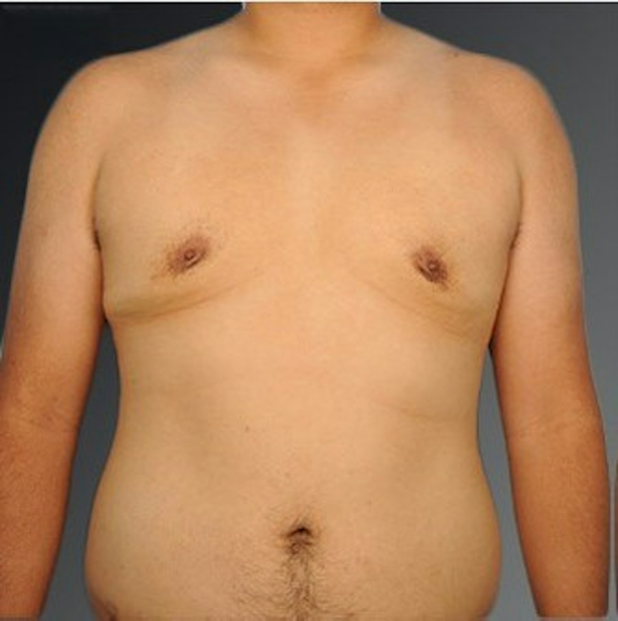 Patient 106041479 | Front View | After | Chest (Gynecomastia) — Steven Teitelbaum MD -