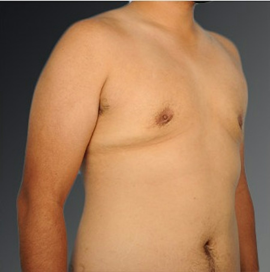 Patient 106041479 | Angle View | After | Chest (Gynecomastia) — Steven Teitelbaum MD -