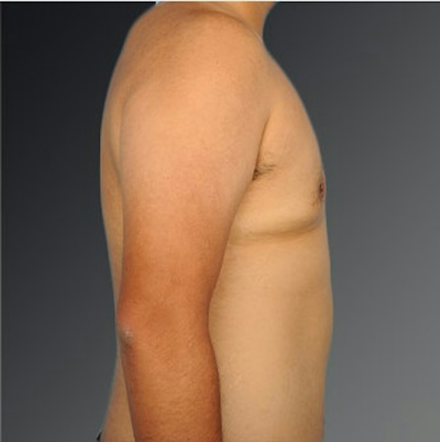 Patient 106041479 | Profile View | After | Chest (Gynecomastia) — Steven Teitelbaum MD -