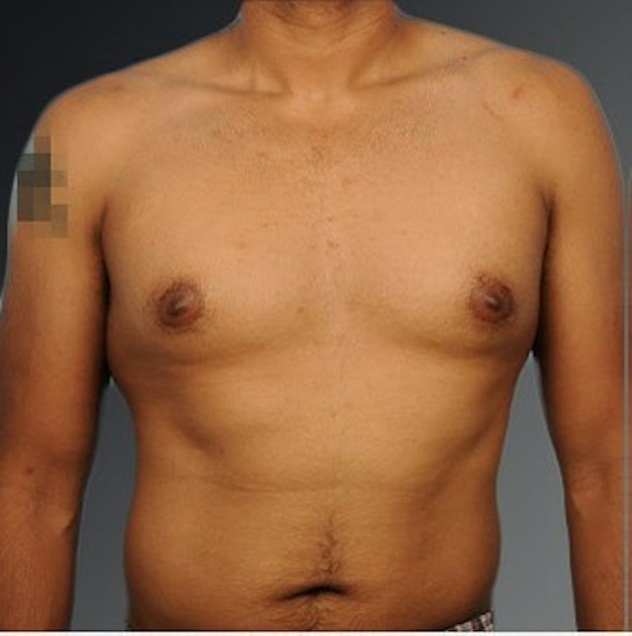 Patient 106041480 | Front View | Before | Chest (Gynecomastia) — Steven Teitelbaum MD -