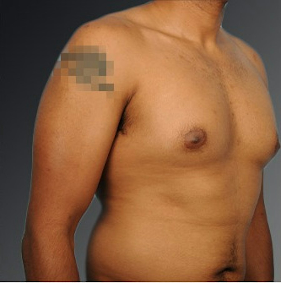 Patient 106041480 | Angle View | Before | Chest (Gynecomastia) — Steven Teitelbaum MD -