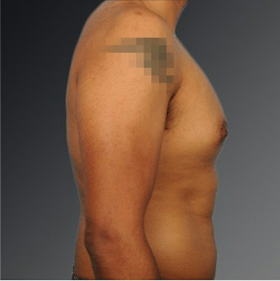 Patient 106041480 | Profile View | Before | Chest (Gynecomastia) — Steven Teitelbaum MD -