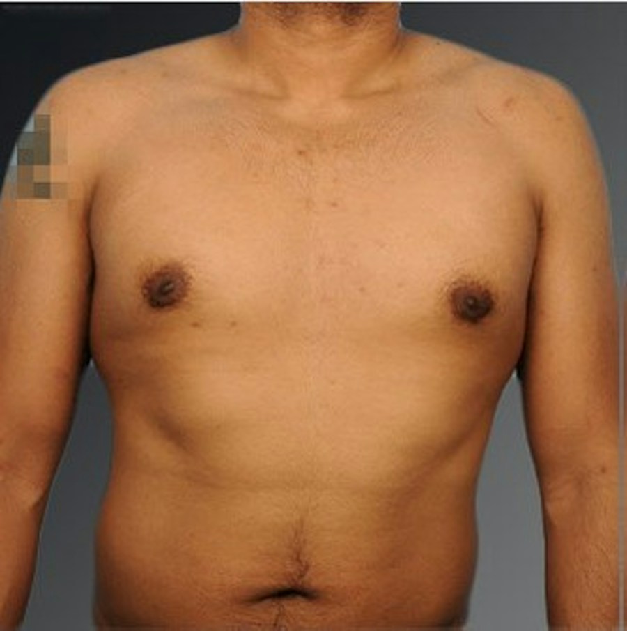 Patient 106041480 | Front View | After | Chest (Gynecomastia) — Steven Teitelbaum MD -