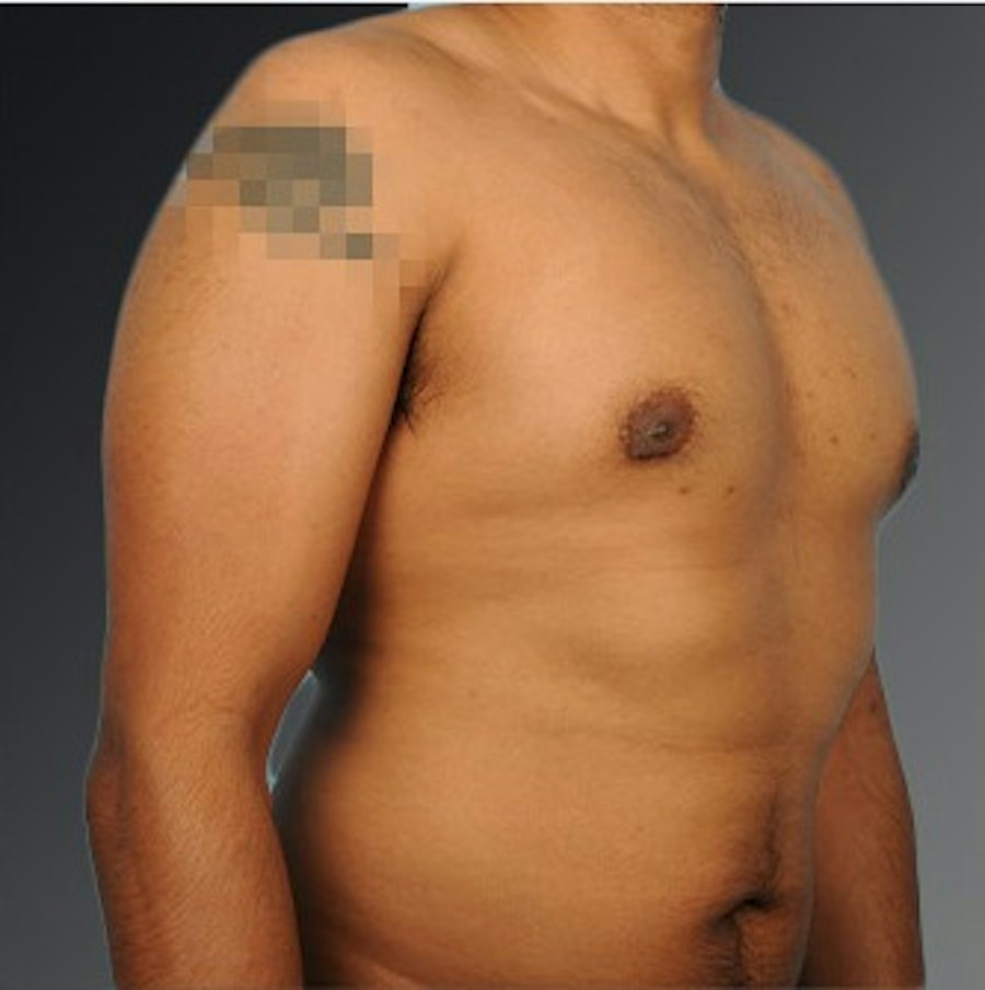 Patient 106041480 | Angle View | After | Chest (Gynecomastia) — Steven Teitelbaum MD -