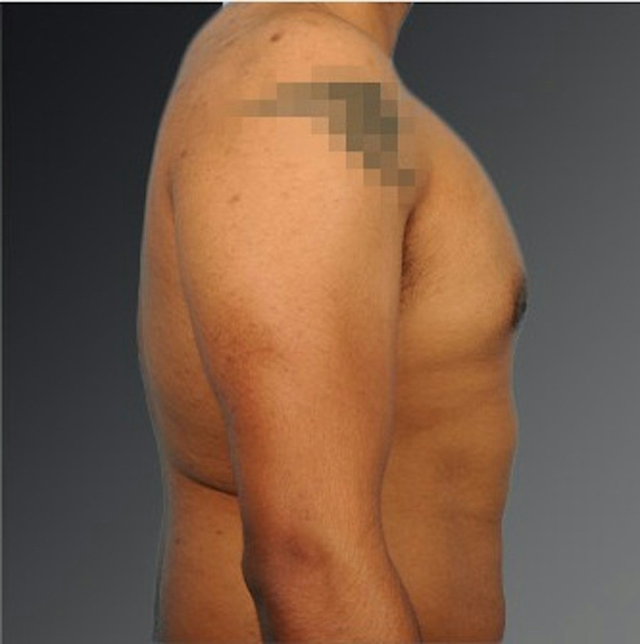 Patient 106041480 | Profile View | After | Chest (Gynecomastia) — Steven Teitelbaum MD -