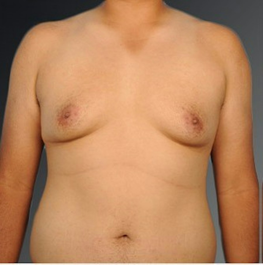 Patient 106041484 | Front View | Before | Chest (Gynecomastia) — Steven Teitelbaum MD -