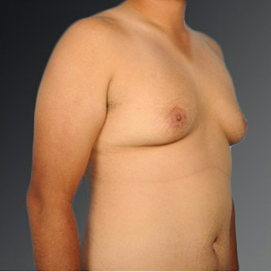 Patient 106041484 | Angle View | Before | Chest (Gynecomastia) — Steven Teitelbaum MD -
