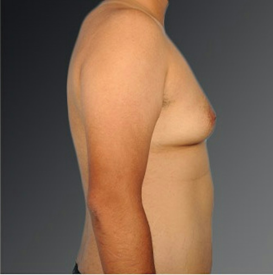 Patient 106041484 | Profile View | Before | Chest (Gynecomastia) — Steven Teitelbaum MD -