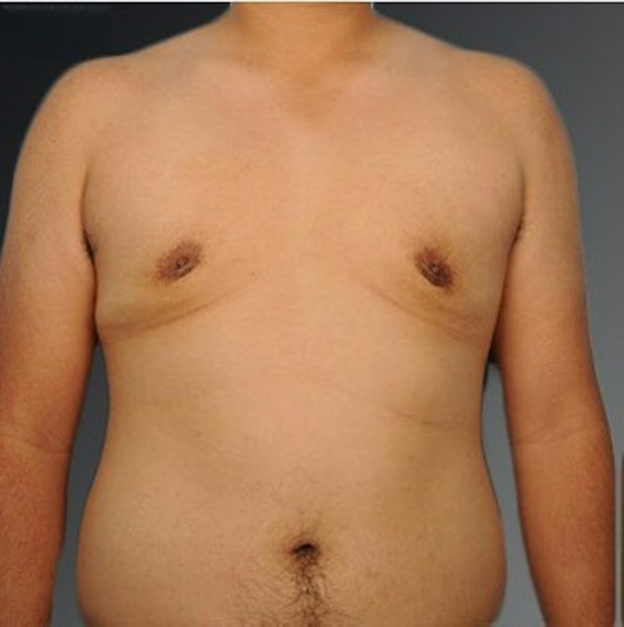Patient 106041484 | Front View | After | Chest (Gynecomastia) — Steven Teitelbaum MD -