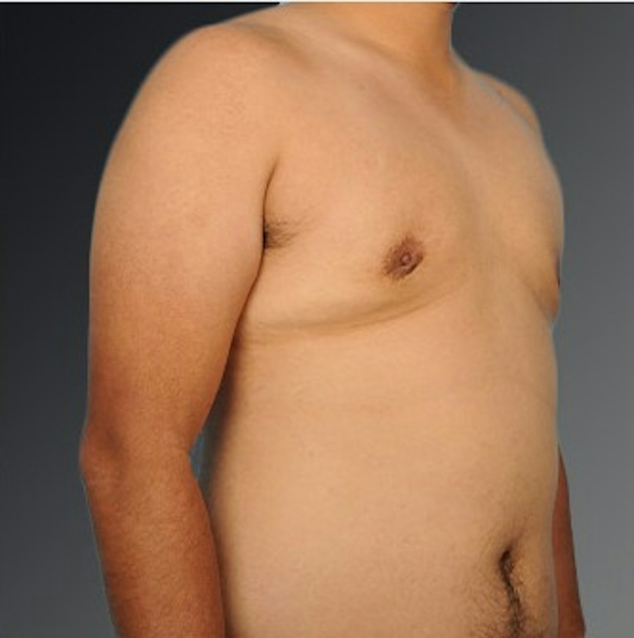 Patient 106041484 | Angle View | After | Chest (Gynecomastia) — Steven Teitelbaum MD -