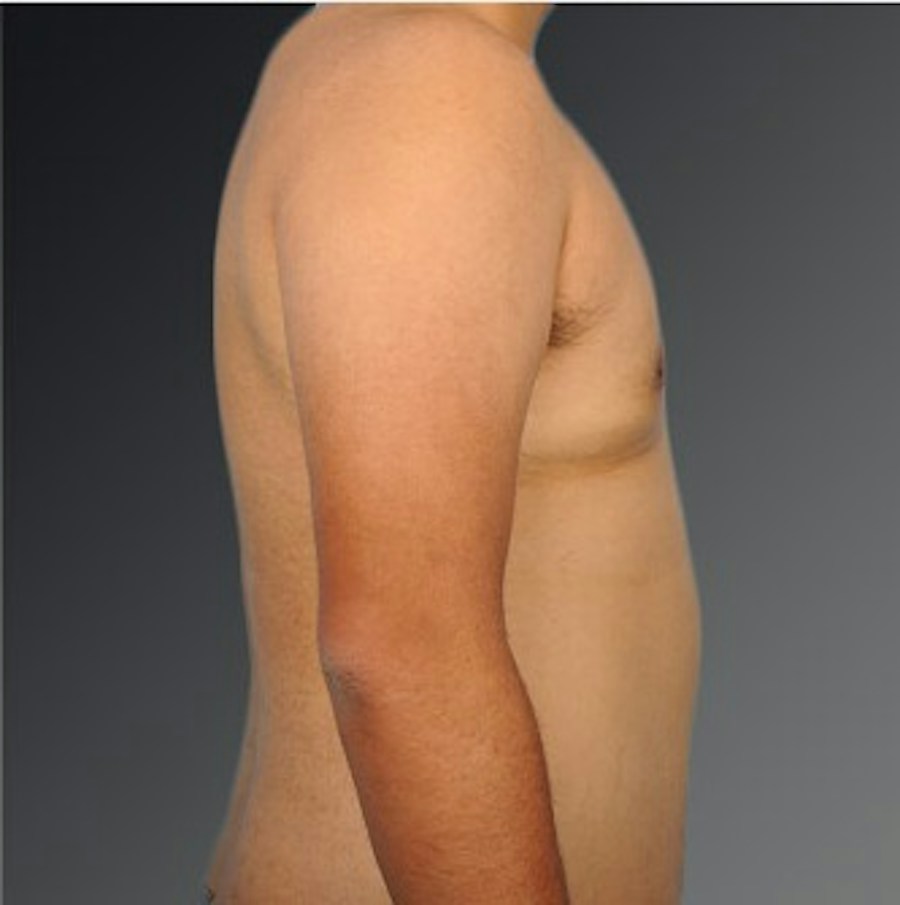 Patient 106041484 | Profile View | After | Chest (Gynecomastia) — Steven Teitelbaum MD -